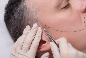 hair-clinic-frankfurt-Baartransplantation
