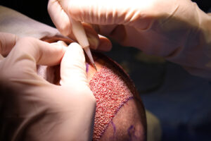 hair-clinic-frankfurt-haartransplantation